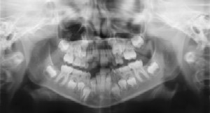 Dental Radiographs (X-Rays) - Pediatric Dentist in Cherry Hill, Swedesboro, and Princton, NJ