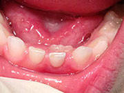 Baby Teeth - Pediatric Dentist in Cherry Hill, Swedesboro, and Princton, NJ