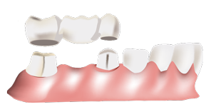 Dental Bridge - Dentist in Cherry Hill, Swedesboro, and Princton, NJ